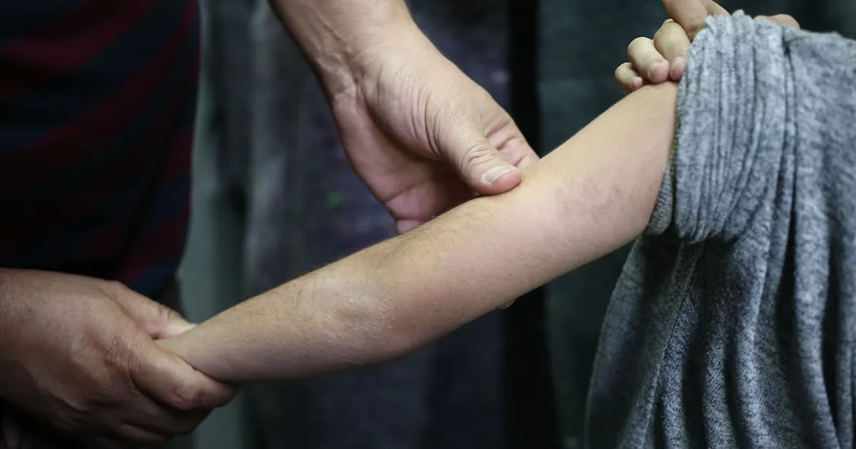 Andradas registra 11 casos de escabiose associados a creche municipal