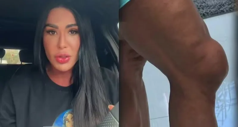 Gracyanne Barbosa relata inchaço no joelho após voltar à Dança dos Famosos